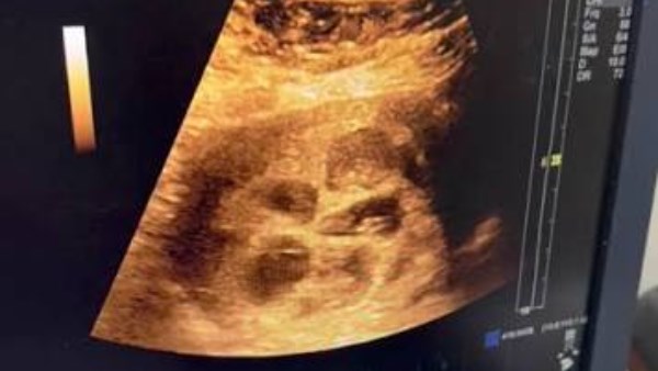 تفاصيل حالة الحمل في 8 توائم