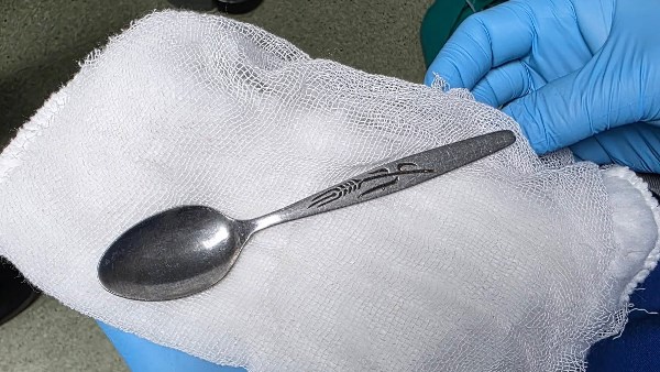 استخراج ملعقة من معدة فتاة 