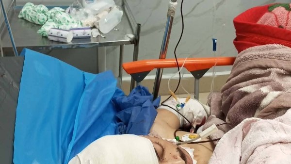 فريق طبي بمستشفى سلام بورسعيد ينجح في إنقاذ ذراع شاب بعد جراحة دقيقة استمرت 14 ساعة