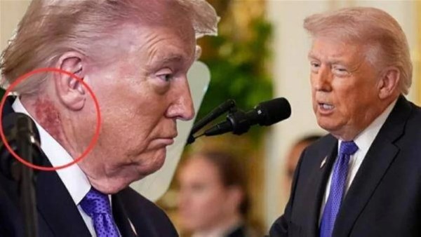 تحت الملاحظة الطبية.. ما سر البقعة الحمراء على رقبة ترامب؟