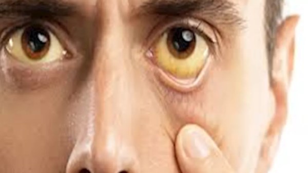 الكبد الدهني وتأثيره على العين: كيف تحمي نفسك؟