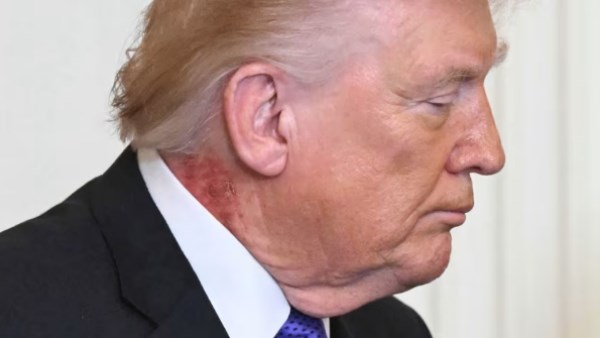 الطفح الجلدي على رقبة ترامب