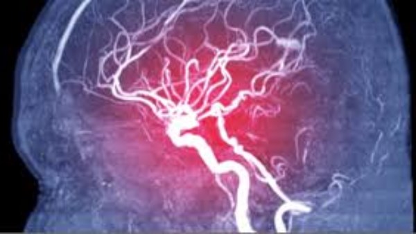  القسطرة المخية 