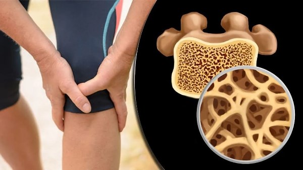 3 هرمونات قد تكون السبب وراء هشاشة العظام..