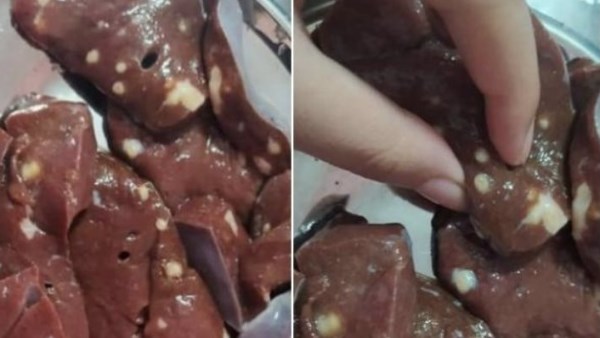 ٦ علامات تكشف الكبد الفاسد