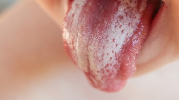  القلاع الفموى ..الاعراض و الوقاية