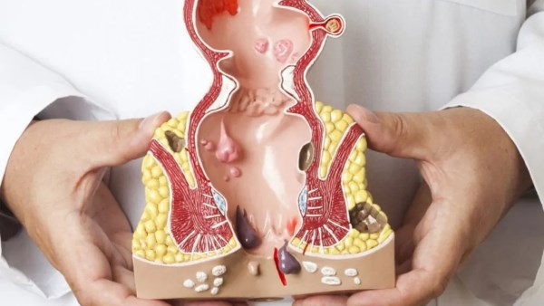 الناسور الشرجى..انتبه من هذه الاعراض