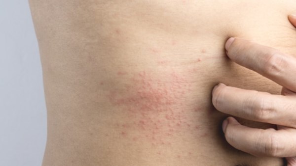 احمي الأماكن الحساسة من التهيّج والعدوى فى الصيف