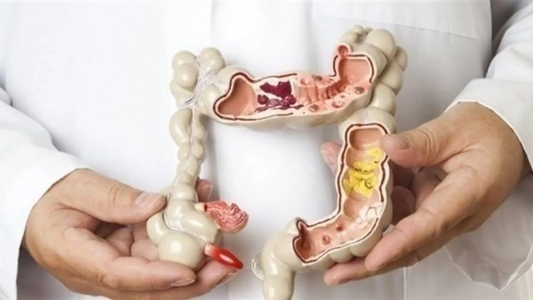 أعراض تهيج القولون العصبي والاطعمة التى يجب الابتعاد عنها