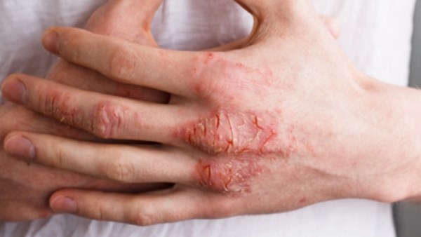 كيف تفرّق بين الصدفية والإكزيما؟ إليك الفروق الأساسية!