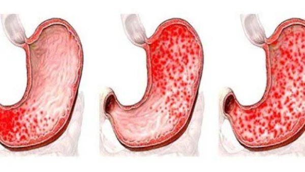 التهاب المعدة .. الاعراض و الاسباب والعلاج