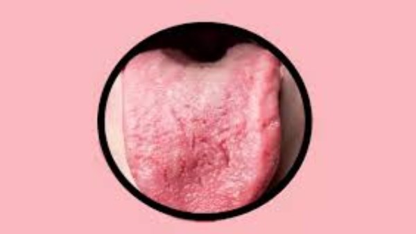 سوء التغذية السبب..تشققات اللسان ترتبط بنقص الفيتامينات