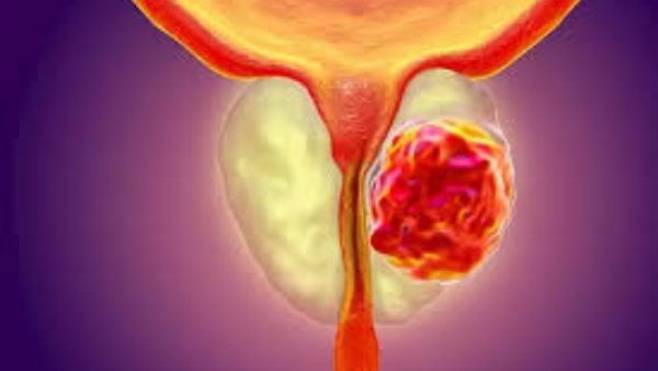 سرطان البروستاتا..علامات تكون جرس إنذار