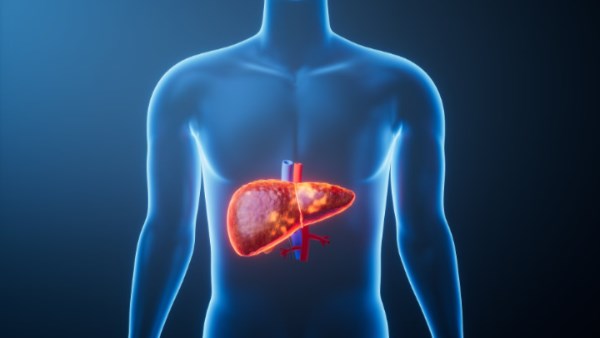 مرض الكبد الدهني