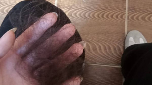 آثار الاعتداء على إحدى الطالبات