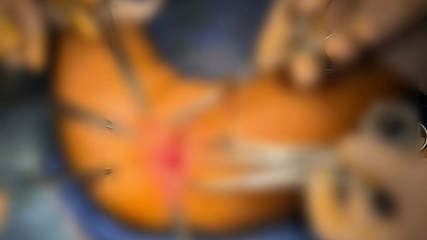 عملية جراحية بطنطا