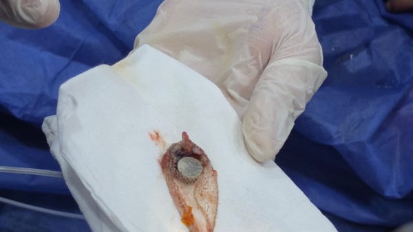 عملية جراحية