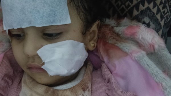 الطفلة المصابة