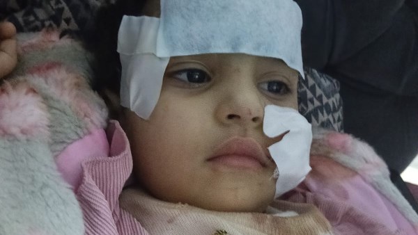 الطفلة بعد إصابتها