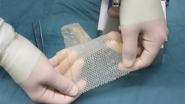 التبرع بالأنسجة