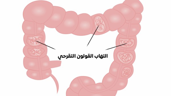 القولون التقرحى.. أنواعه و أسبابه تعرف عليها