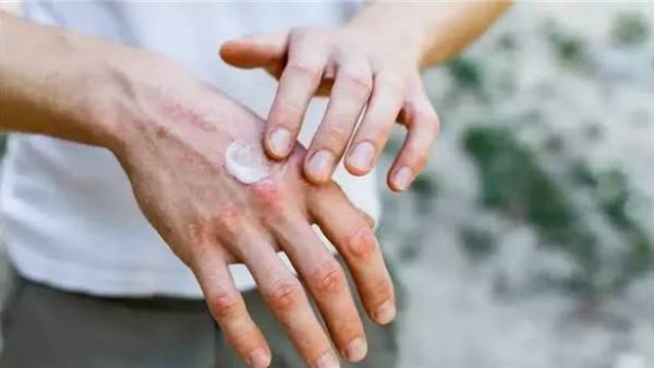 سحب كريم الأكزيما من الأسواق بعد اكتشاف بكتيريا خطيرة