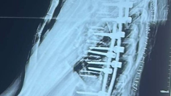 نجاح جراحة دقيقة ومعقدة لشاب يعاني من تشوهات شديدة بالعمود الفقري داخل مستشفيات جامعة الأزهر بأسيوط