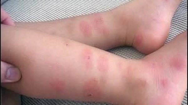 طبيب أطفال يحذر من انتشار الحساسية الحشرية بين الأطفال خلال 