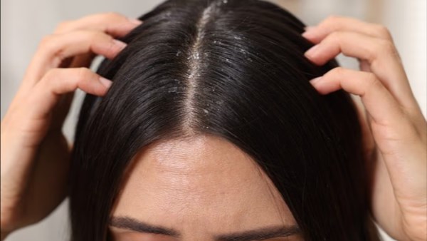 هل قشرة الشعر دليل على قلة النظافة