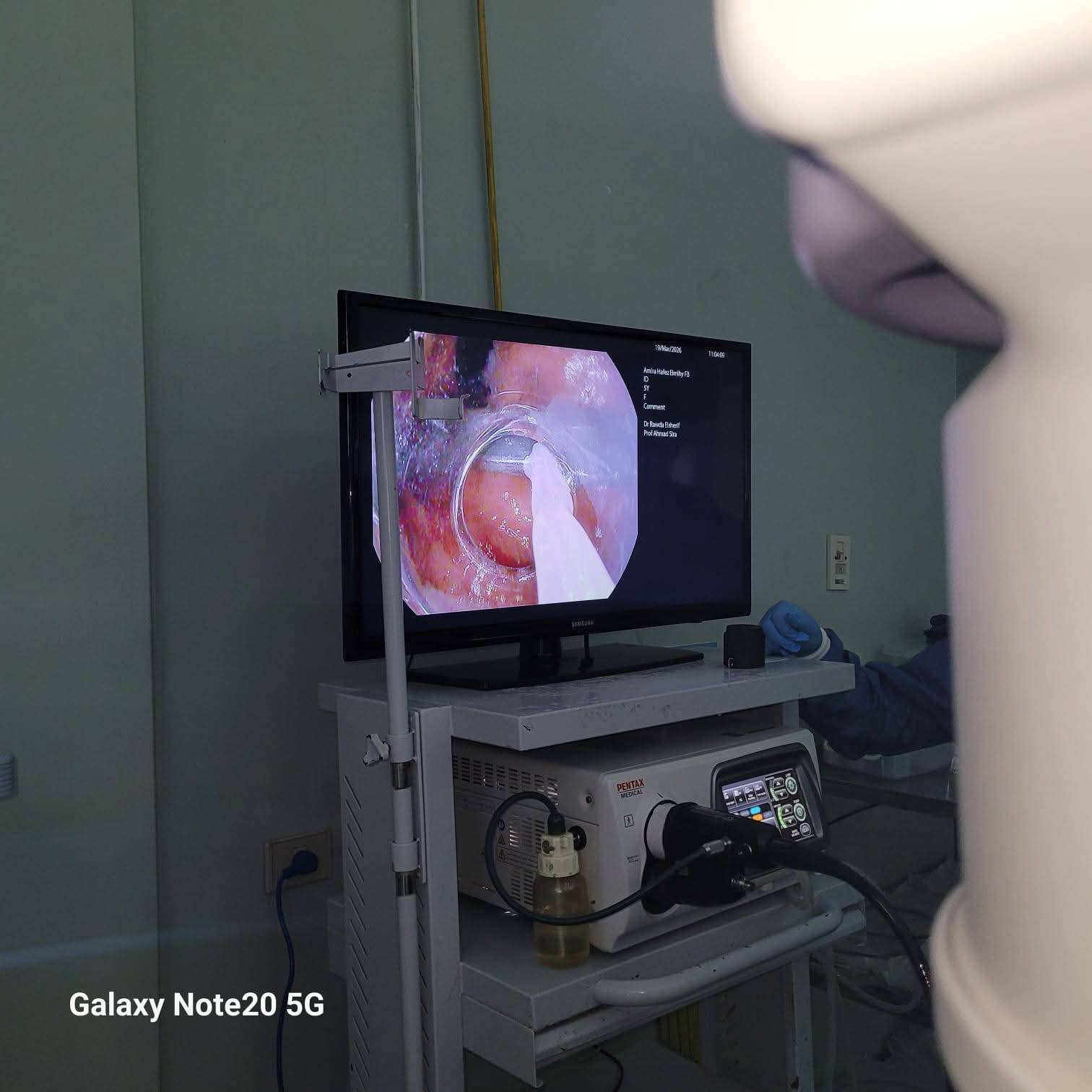 &nbsp;جسم معدني داخل المعدة
